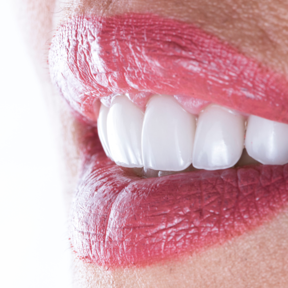 Smile Makeover (Gülüş Tasarımı)